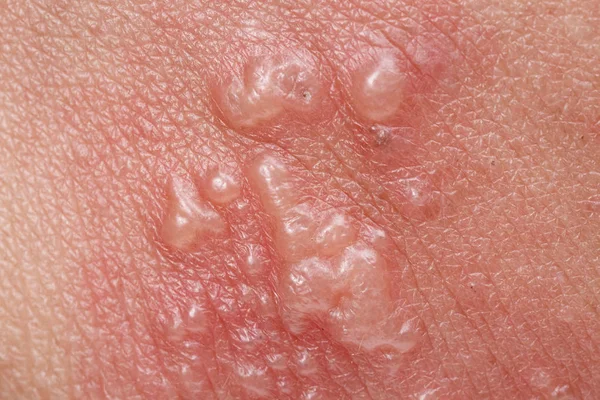 Herpes zóster, herpes zóster o herpes zóster en el brazo —  Fotos de Stock