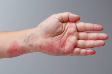 Kolda Zona, Zoster veya Herpes Zoster belirtileri