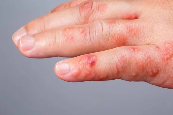Черепица, Зостер или герпес Зостер симптомы на руке — стоковое фото