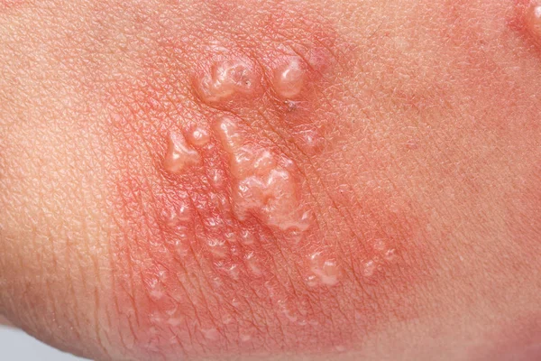 Herpes zoster o herpes zoster sintomi sul braccio — Foto Stock