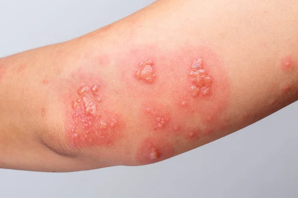 Shingles, Zoster ou Herpes Zoster sintomas no braço — Fotografia de Stock