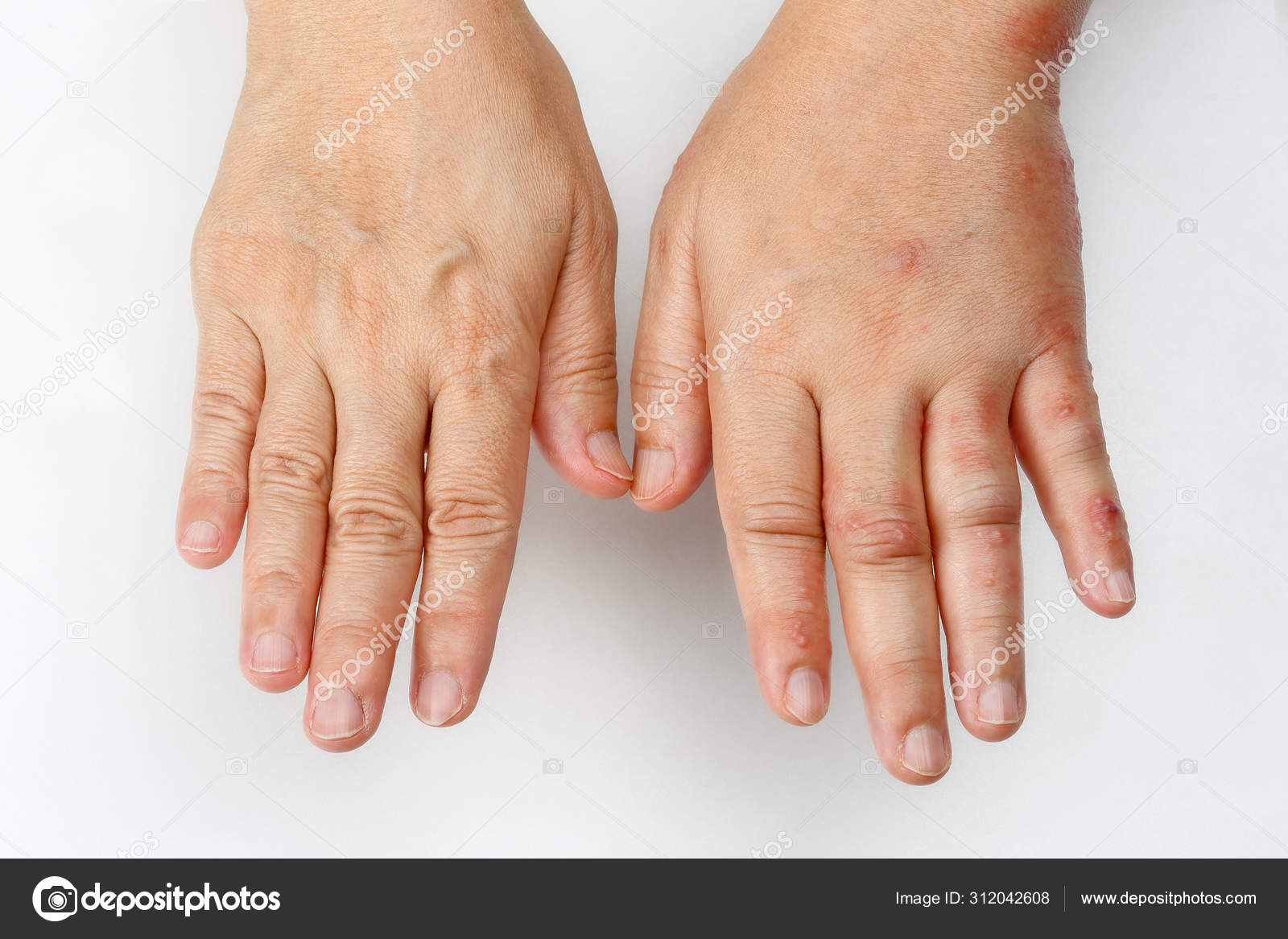 Отеки на ногах с утра причина. Отекают руки по утра причины. Как определить утренние отеки. Отекают пальцы рук по утрам. Почему на утро отекают руки.