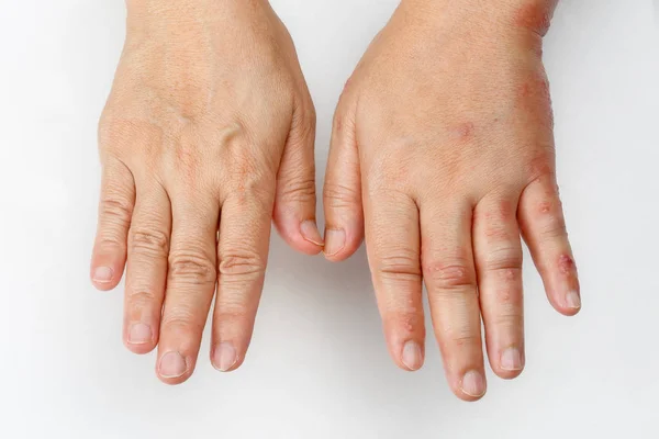 Gürtelrose, die eine geschwollene Hand verursacht — Stockfoto