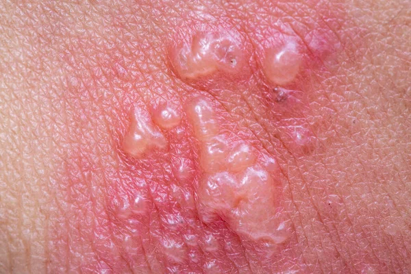 Herpes Zoster Herpes Zoster Sintomi Sul Braccio — Foto Stock
