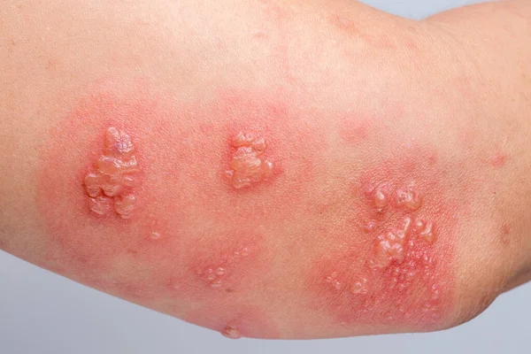 帯状疱疹 帯状疱疹またはヘルペス帯状疱疹の腕の症状 — ストック写真