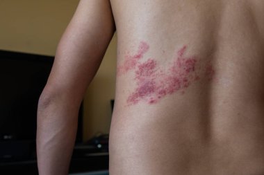 herpes zoster arka kapat