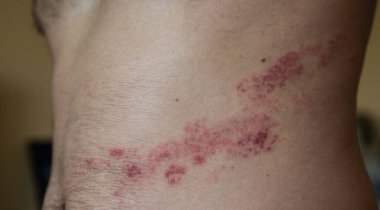herpes zoster mide üzerinde Kapat