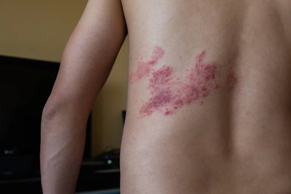 Nahaufnahme Von Herpes Zoster Auf Dem Rücken — Stockfoto