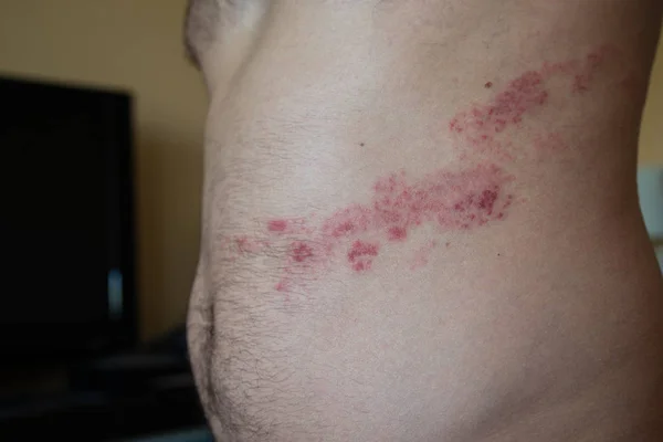 herpes zoster mide üzerinde Kapat