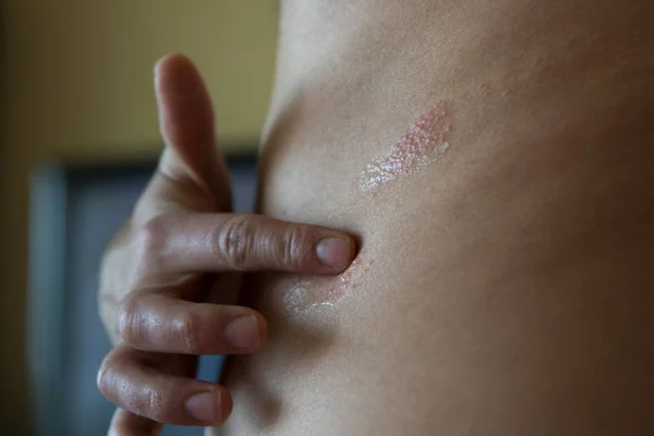 İnsan derisindeki zoster hastalığına yakın.