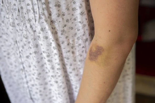 Conceito Violência Doméstica Mulher Abusada Mostra Mãos Com Hematomas — Fotografia de Stock