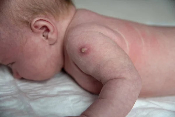 新生児の結核病ワクチン — ストック写真
