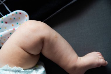 atopik dermatit yakın, ilk belirtiler