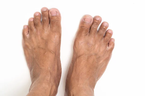 Asian man foot brown and dry skin Stock Picture
