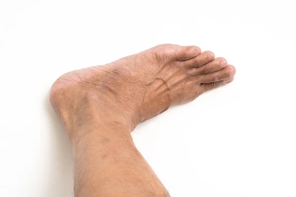 亚洲男子脚棕色和干燥的皮肤 — 图库照片
