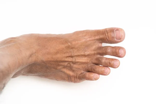 Ασιάτης/ισσα άνθρωπος πόδι καφέ και ξηρό δέρμα — Φωτογραφία Αρχείου
