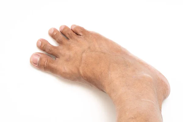 Asian man foot brown and dry skin — Stock Photo, Image