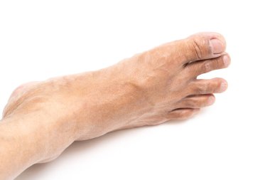 Asyalı adam ayak kahverengi ve kuru cilt