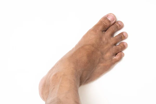 Hombre asiático pie marrón y piel seca — Foto de Stock