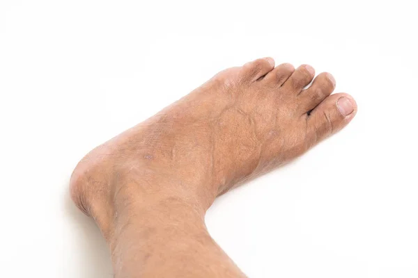 Homem asiático pé marrom e pele seca — Fotografia de Stock
