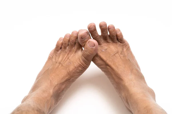 Hombre asiático pie marrón y piel seca —  Fotos de Stock