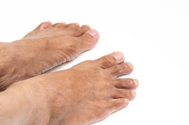 Asyalı adam ayak kahverengi ve kuru cilt