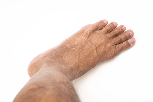 Asiatische Mann Fuß braun und trockene Haut — Stockfoto