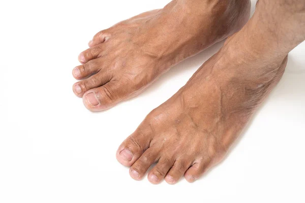 Homem asiático pé marrom e pele seca — Fotografia de Stock