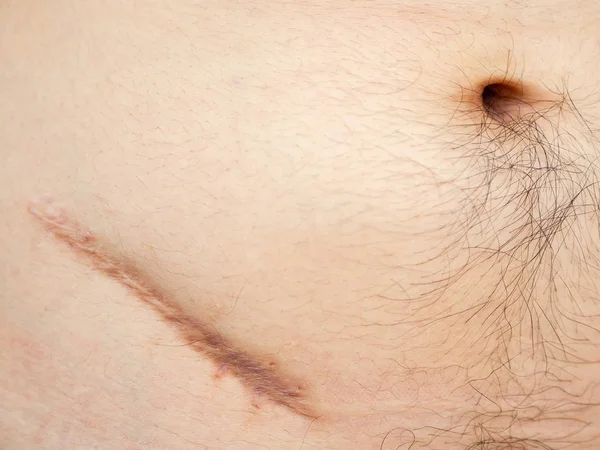 Closeup Man Showing Stomach Scar Appendicitis Surgery — Stock Photo, Image