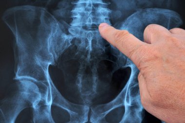 Omurganın röntgeni