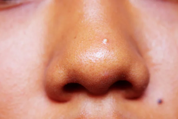 Pimple of Nose — Stock Photo, Image