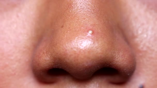 にきびと黒ずみのある茶色の皮膚の鼻の先端 — ストック動画