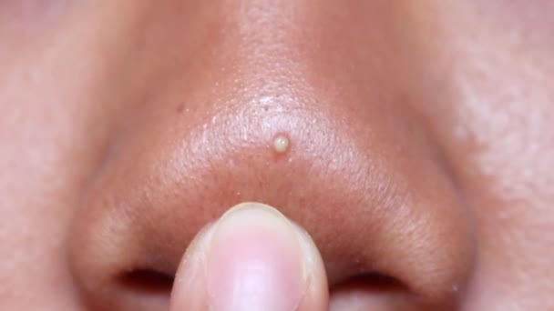 鼻子上的粉刺 — 图库视频影像