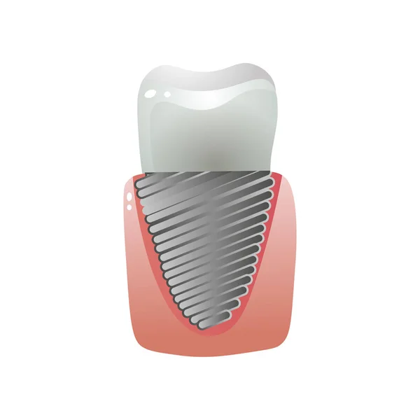 Metalen stalen keramische witte tand implantaat, moderne technologie — Stockvector