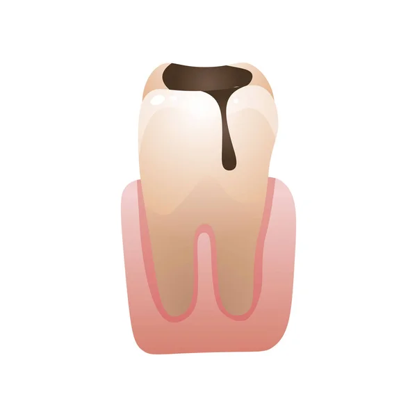 Gebarsten zieke tand met tandheelkundige gele steen en cariës — Stockvector