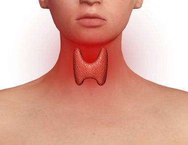 Tiroid bezi endokrin bozulma, iltihabı ve şişmiş bir kadınla boyun maruz. Endokrin sistem hastalıkları. 3D çizim