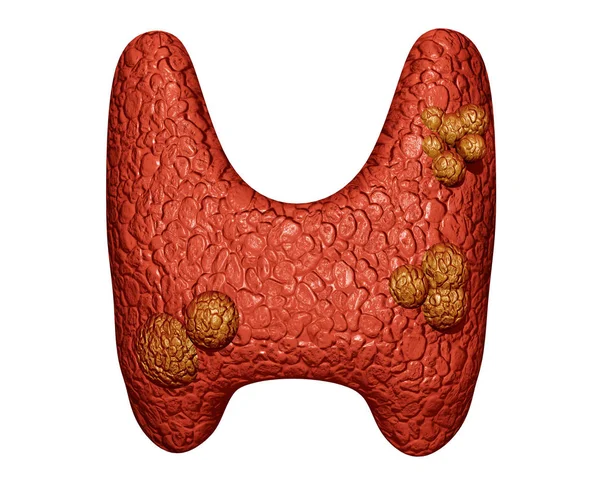 Primer Plano Cáncer Tiroides Desarrollo Cáncer Glándula Tiroides Ilustración Aislada —  Fotos de Stock