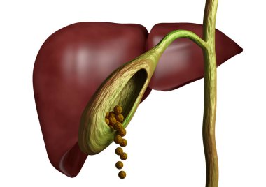 Gallstones in gallbladder and bile duct isolated white background clipart