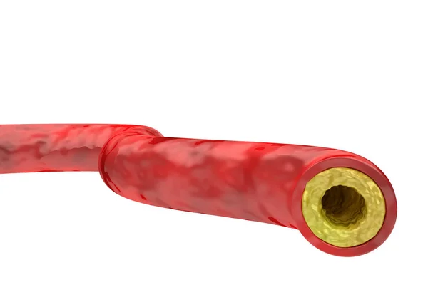 흰색 배경에 고립 된 콜레스테롤 플레이트 누적 된 동맥 — 스톡 사진