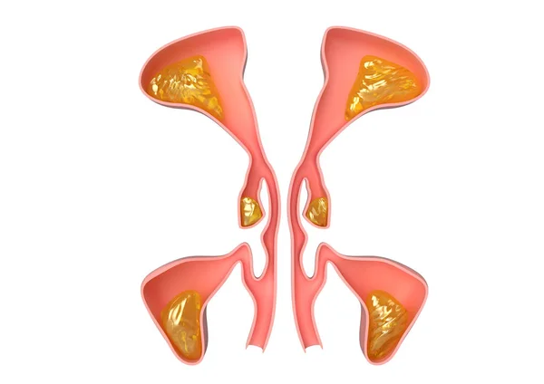 Seno nasal con demostración interna de sinusitis, inflamación facial que provoca cefalea y malestar — Foto de Stock