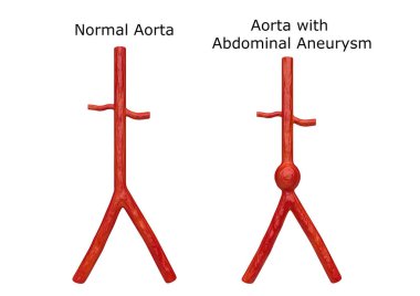 Torasik ve abdominal bölgede normal aort ve aort anevrizması gösteren insan vücudunun iç görünümü