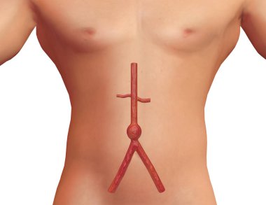 Torasik ve abdominal bölgede aort anevrizması gösteren insan vücudunun iç görünümü