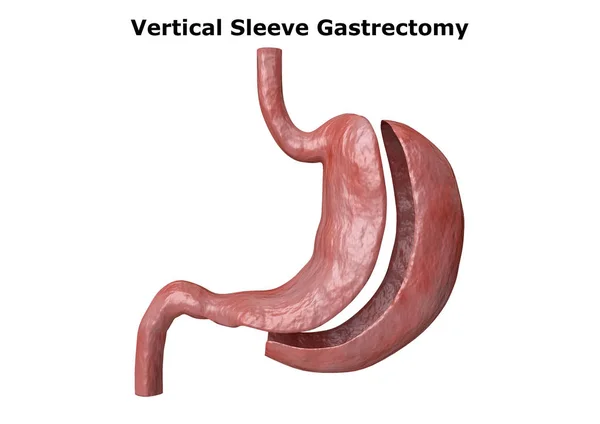 Vertical sleeve gastrectomy. Bariatric surgery with reduction of the size of the stomach for weight loss and loss of body weight — Stock Photo, Image