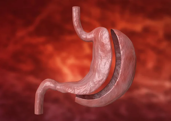 Verticale mouw Gastrectomie. Bariatrische chirurgie met vermindering van de grootte van de maag voor gewichtsverlies en verlies van lichaamsgewicht — Stockfoto