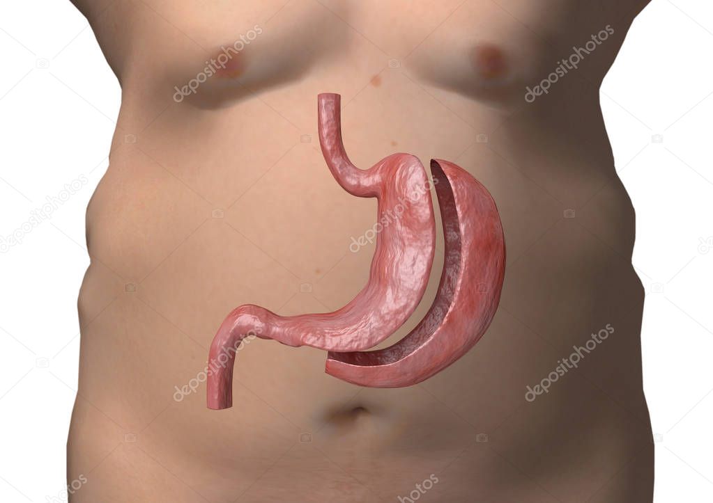 vertical sleeve gastrectomy. Bariatric surgery with reduction of the size of the stomach for weight loss and loss of body weight