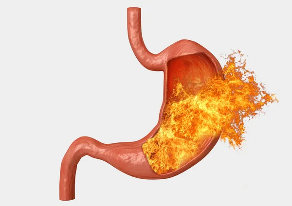 Fuego del estómago. acidez excesiva, indigestión, enfermedad estomacal, úlcera gástrica, dolor abdominal intenso —  Fotos de Stock