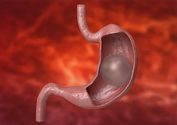 Globo gástrico. dispositivo inflable que se coloca en el estómago para reducir el peso — Foto de Stock