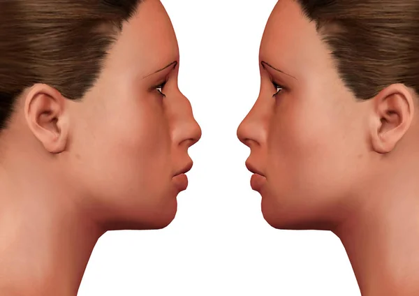 Mulher jovem antes e depois da rinoplastia em fundo branco. Cirurgia plástica — Fotografia de Stock