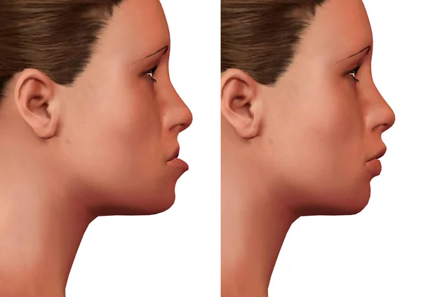 Cirurgia ortognática, correção da deformidade mandibular humana, antes e depois, visão lateral — Fotografia de Stock