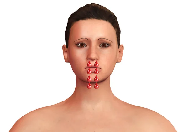 Wanita muda dengan gejala hemofilia dengan hidung berdarah berlebihan — Stok Foto